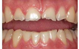 چه چیزی باعث خرد شدن دندان ها می شود؟