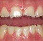 چه چیزی باعث خرد شدن دندان ها می شود؟